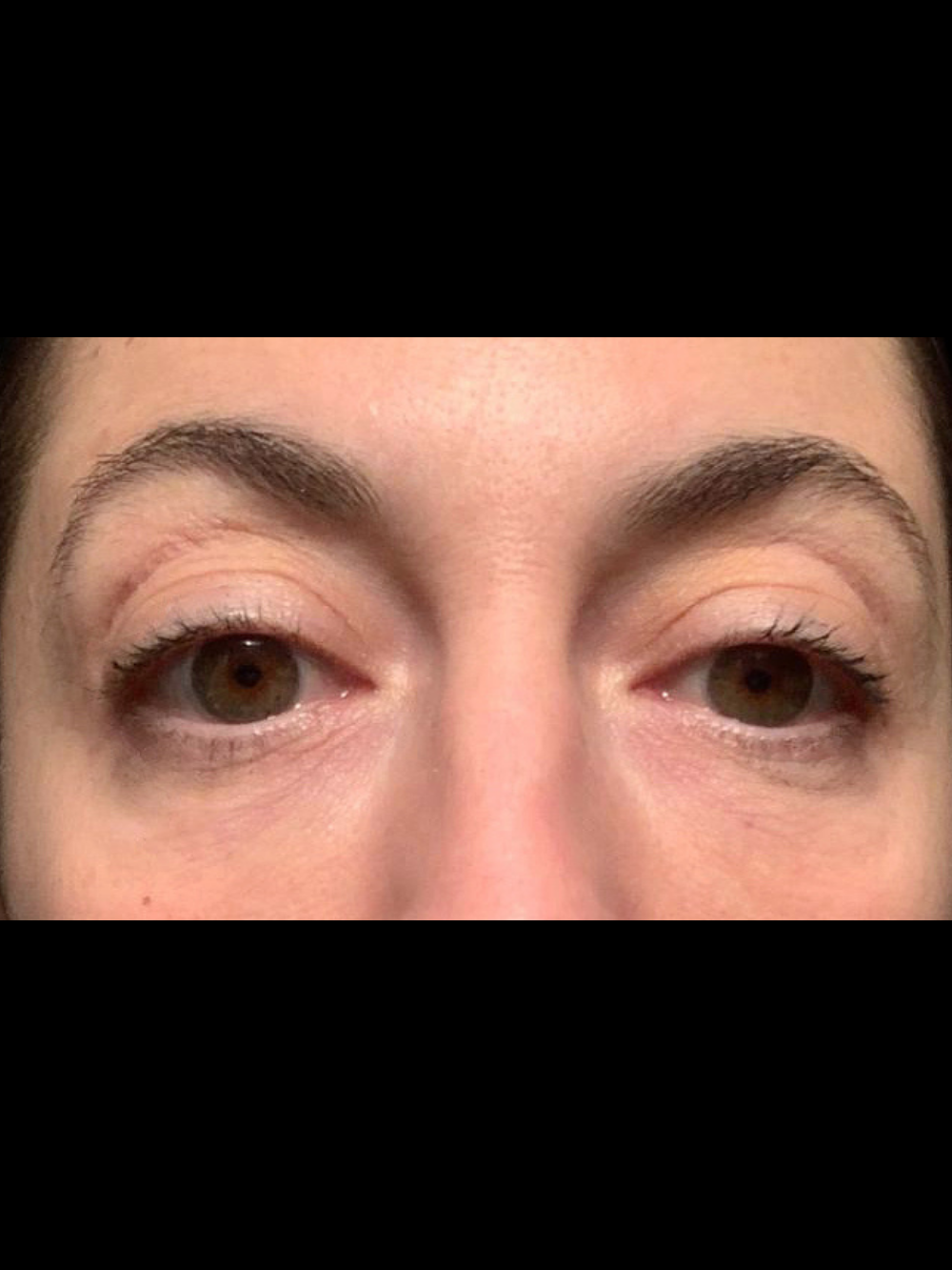 filler-perioculare-dopo