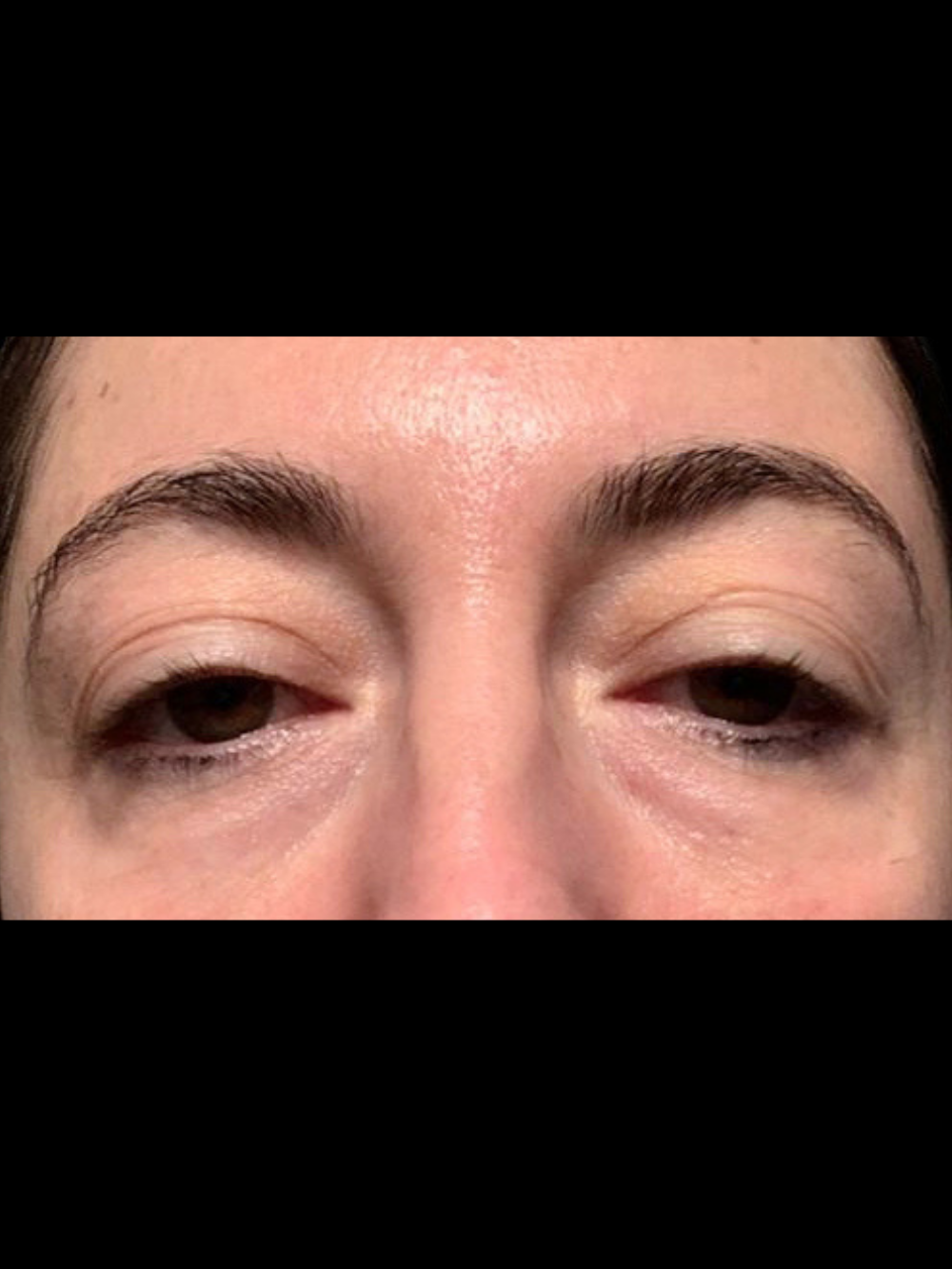 filler-perioculare-prima